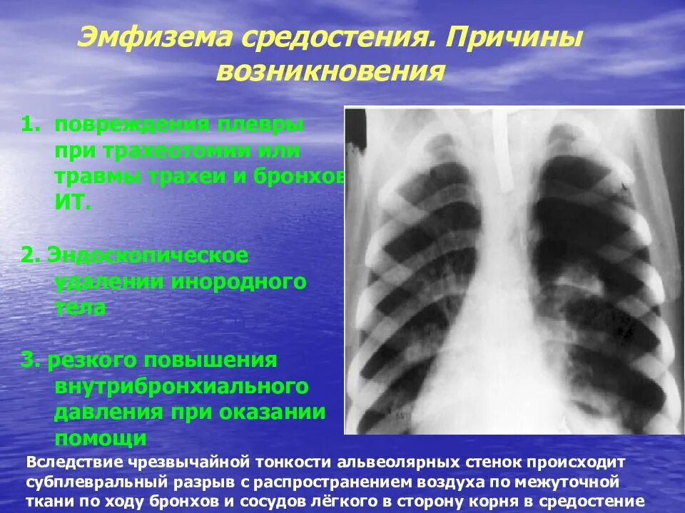 Признаки воздуха в легких. Спонтанная эмфизема средостения. Эмфизема средостения рентген. Эмфизема средостения рентгенограмма.