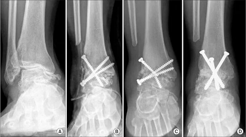 После артродеза голеностопного сустава. Внутрисуставной артродез. Операция артродез голеностопного сустава. Подтаранный артродез рентген. Артродез коленного аппарат Илизарова.