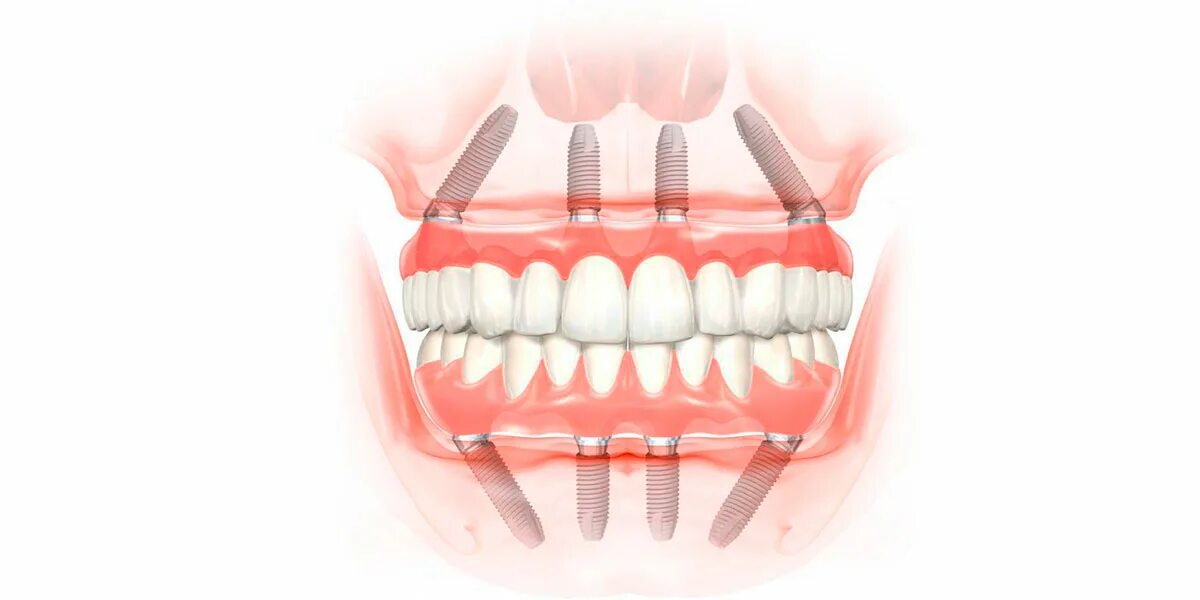 All on 4 имплантация Нобель. Имплантация челюсти на 4 имплантах. Импланты Nobel all-on 04 зубов.
