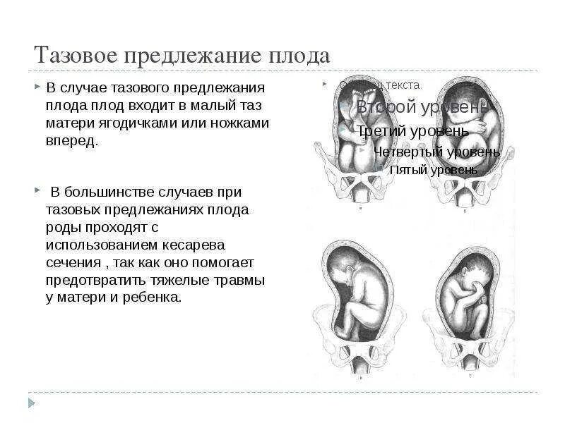 Тазовое предлежание на УЗИ. Продольное поперечное косое положение плода. Положение плода продольное предлежание головное. Неправильное головное предлежание.