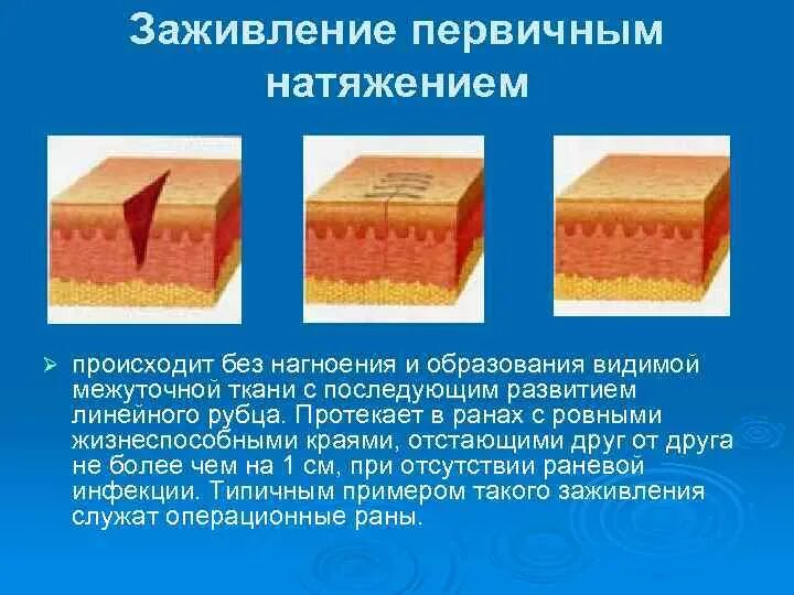 Заживление фото. Типы заживления РАН первичное натяжение. Заживление РАН хирургия вторичная натяжение. Заживление РАН первичным и вторичным натяжением. Заживления РАН грануляция.