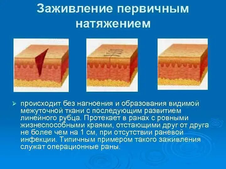 Заживление РАН вторичным натяжением патанатомия. Этапы заживления РАН патанатомия. Заживления РАН грануляция. Заживление РАН патологическая анатомия. Трещина заднего зажила