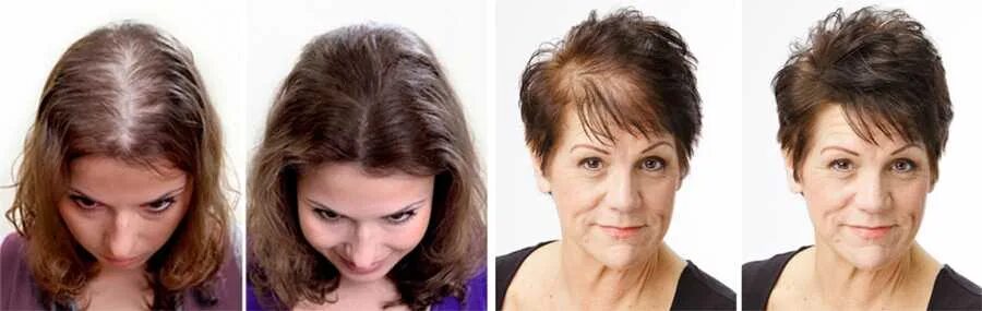 Эффект после лечения. Мезотерапия волос до и после. Плазмолифтинг волос до и после. Плазмотерапия для волос до и после. Мезотерапия волос до и после фото.