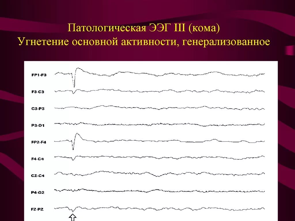 Патологическая ээг