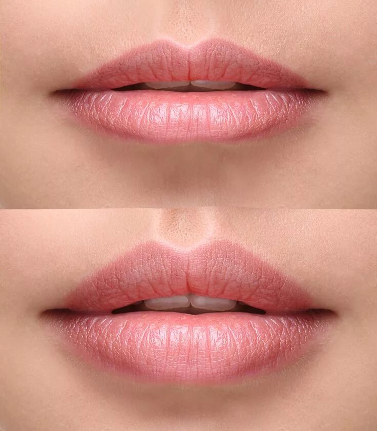 Pin on My Style Botox lips, Lip fillers, Lip implants