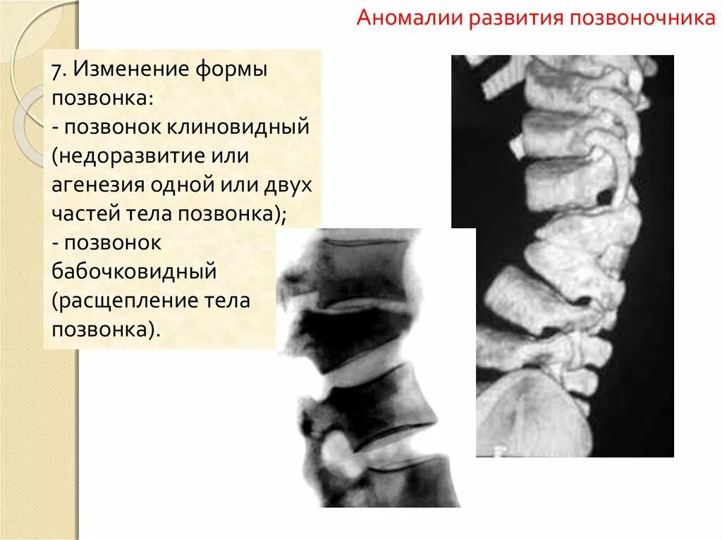 Аномалия сегментации позвонков. Аномалия развития позвонков грудного отдела. Врожденная патология позвоночника. Бабочковидные позвонки.