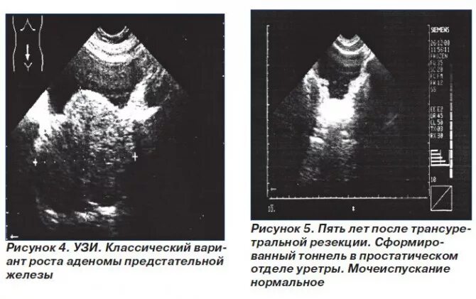 УЗИ предстательной железы. + Портал радиологов