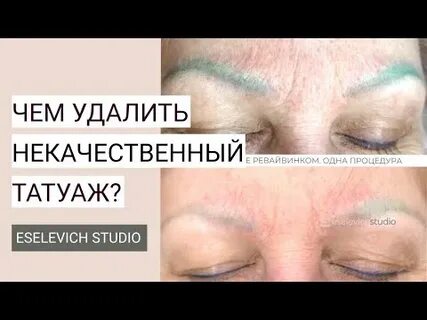 Удаление татуажа форум