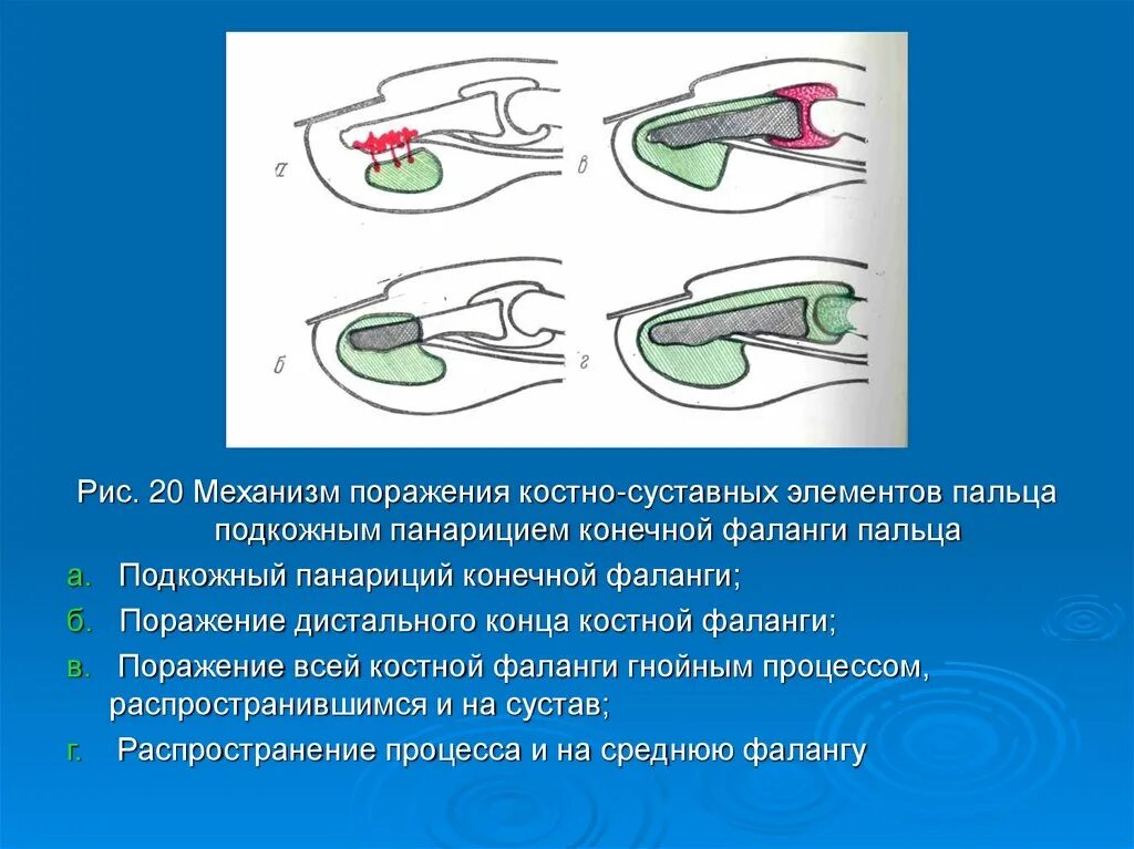 Околоногтевой панариций (паронихия). Панариций мазь отзывы. Панариций мазь отзывы. Панариций мазь отзывы. Антибактериальные мази при панариции пальца.