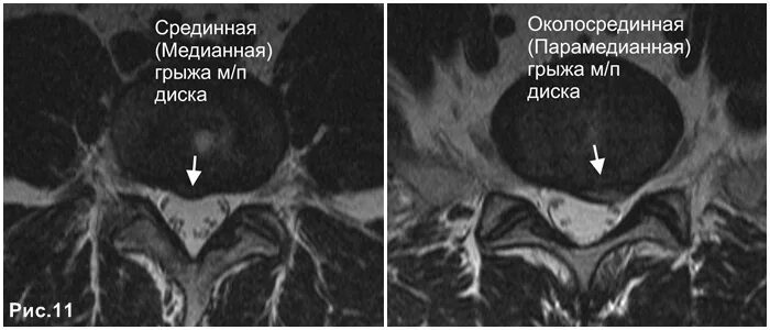 Медианно парамедианная билатеральная. Медиальная парамедиальная грыжа диска l5 s1. Дорзальная медианно-парамедианная грыжа l5-s1 диска. Медианно-парамедианная билатеральная грыжа диска l5-s1. Задняя парамедианная грыжа l5.