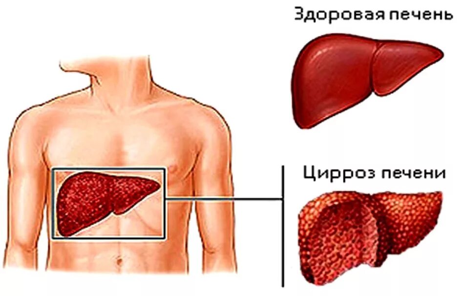 Заболевание печен. Заболевание цирроз печени. Мелкоузловой цирроз печени. Клинические симптомы цирроза печени. Гепатитный цирроз печени симптомы.