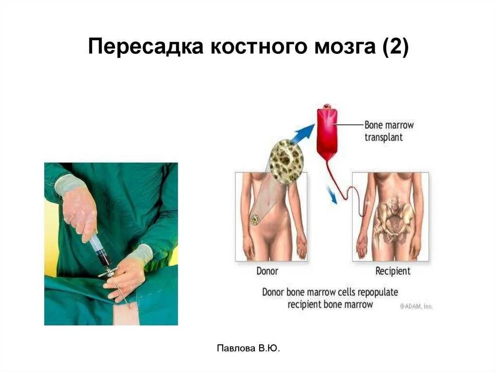 Физиологические основы пересадки костного мозга.. ТКМ трансплантация костного мозга. Пересадка костного мозга при лейкозе. Острый лейкоз пересадка костного мозга. Пересадка костного мозга что это