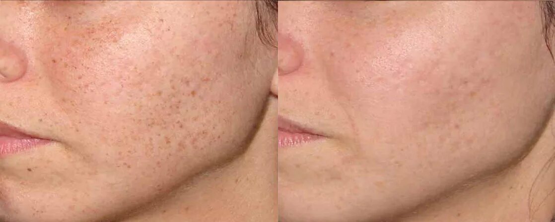 Омоложение сосудов. Фотоомоложение ipl m22. фототерапия м22 пигментация. пигментация пятна постакне.