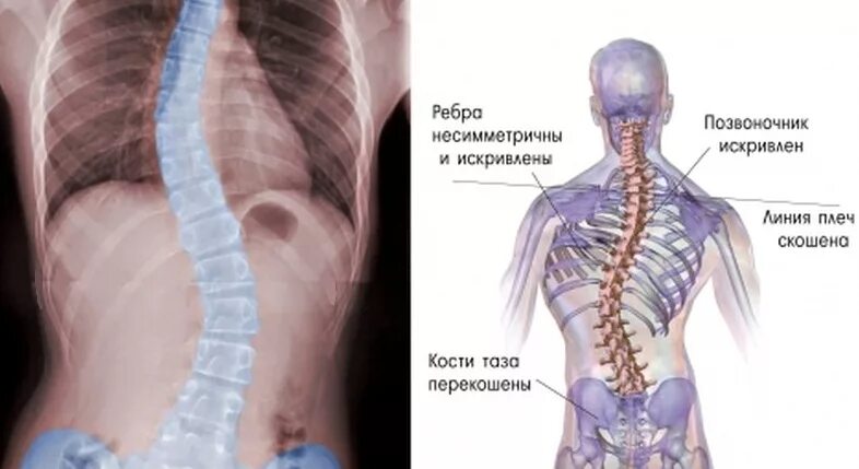 Нарушение статики поясничного отдела позвоночника. Статические нарушения пояснично-крестцового отдела позвоночника. Нарушение функции позвоночника. Нарушение статики шейного отдела позвоночника что это такое.