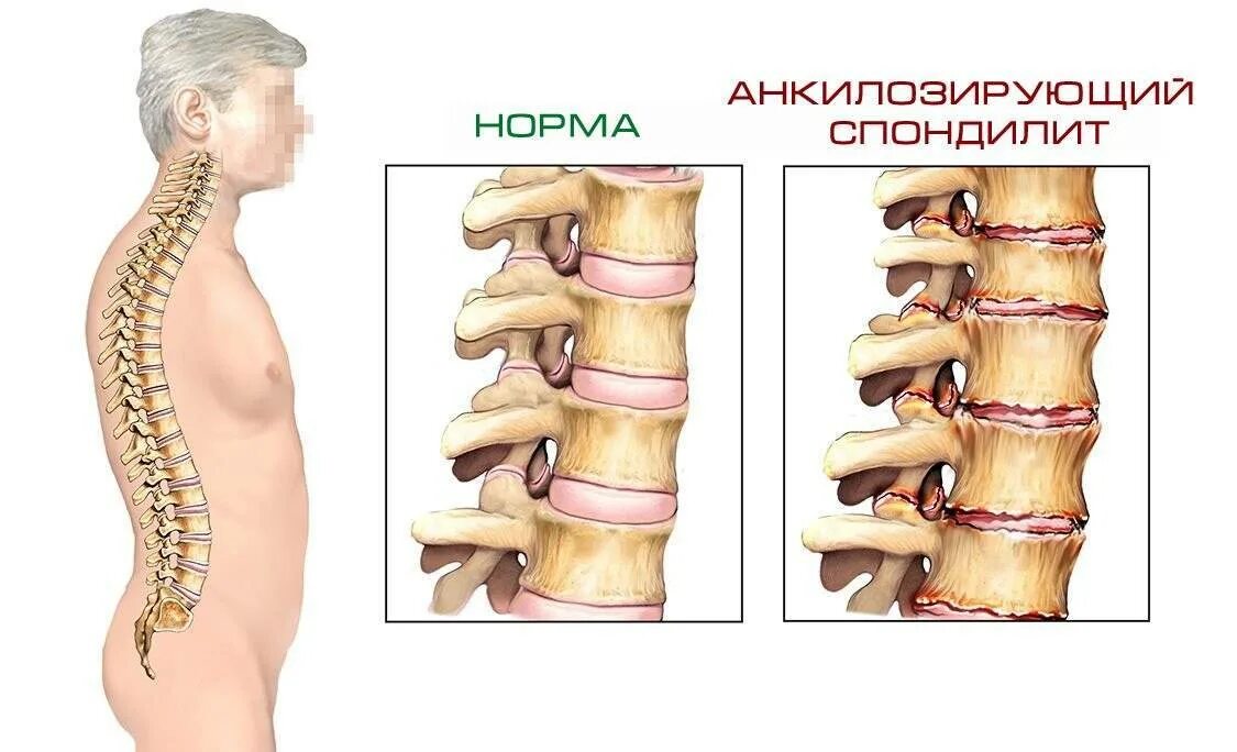 Анкилозирующий спондилит болезнь Бехтерева. Анкилозирующий спондилез это болезнь Бехтерева. Спондилит анкилозирующий поясничного отдела позвоночника. Спондилоартроз болезнь Бехтерева. Картина спондилеза