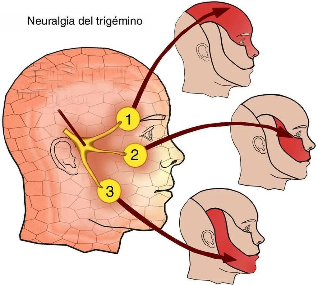 Как отличить зубную боль от тройничного. Тройничный нерв. Тройничный нерв нерв. Лицевой троичный тройничный нерв. Тройничный нерввлсполение.