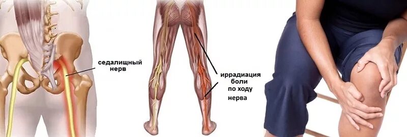 Сильные боли при разгибании колена. Седалищный нерв в колене. Защемление внутри колена.