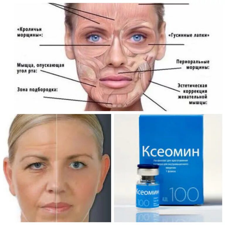 Ботулинотерапия релатокс