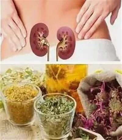 Народное лечение камней в почках