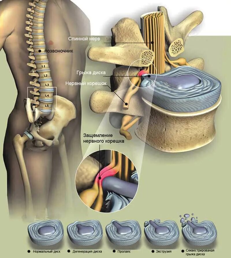 Грыжа поясничного отдела лечение у мужчин симптомы. Компрессия s1 корешка позвоночника.. L5/l5 диск позвоночника. Спинная грыжа. Дискэктомия поясничного отдела l5-s1.