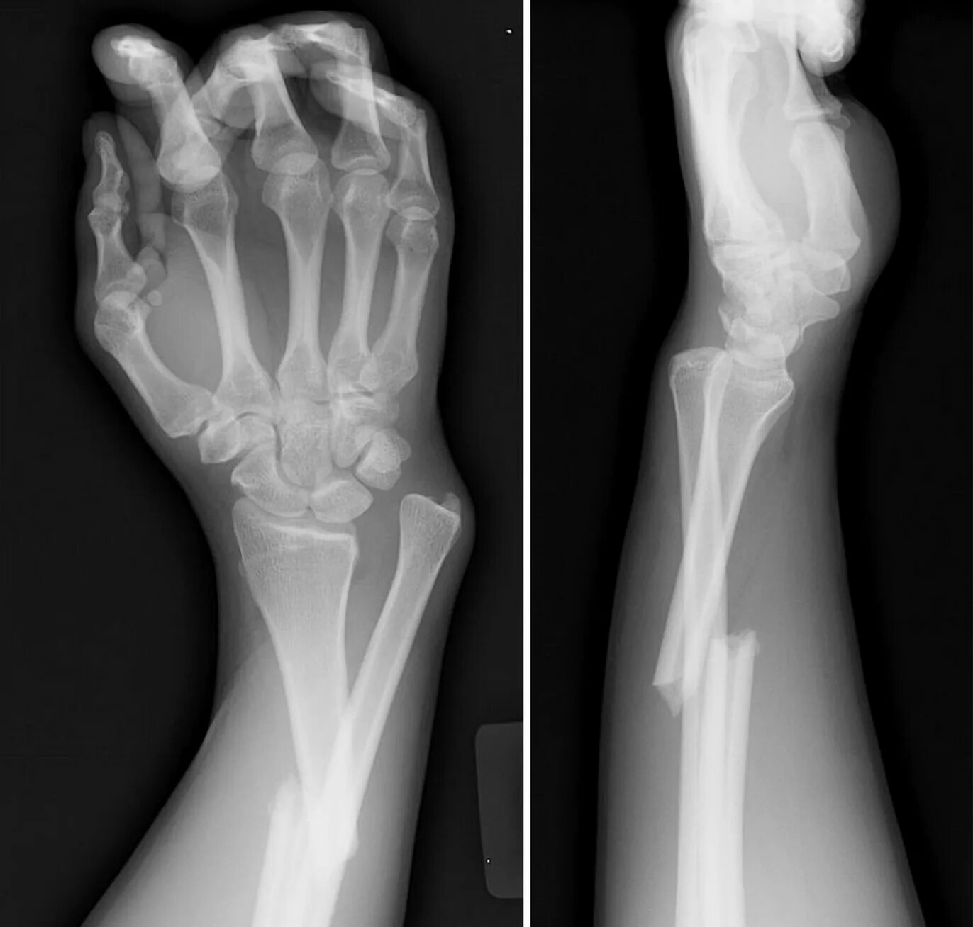 Перелом со смещением отломков рентген. Рентген перелома лучевой кости руки. Перелом лучевой кости со смещением рентгенограмма. Рентген перелома кости предплечья.