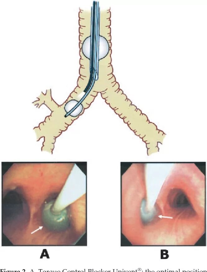 Спадение бронха