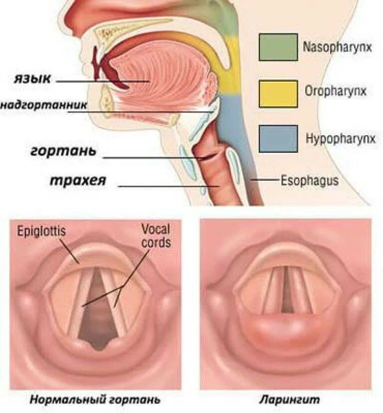 Ларингит (воспаление гортани),. Подсвязочный ларингит. Фарингит на надгортаннике. Ларингит голосовые складки.