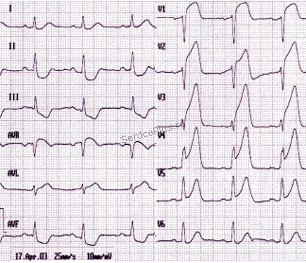 Экг подъем. Инфаркт миокарда с подъемом сегмента St ЭКГ. ОИМ С подъемом St ЭКГ. Элевация St в v2 на ЭКГ. Инфаркт миокарда на ЭКГ С подъемом ст.