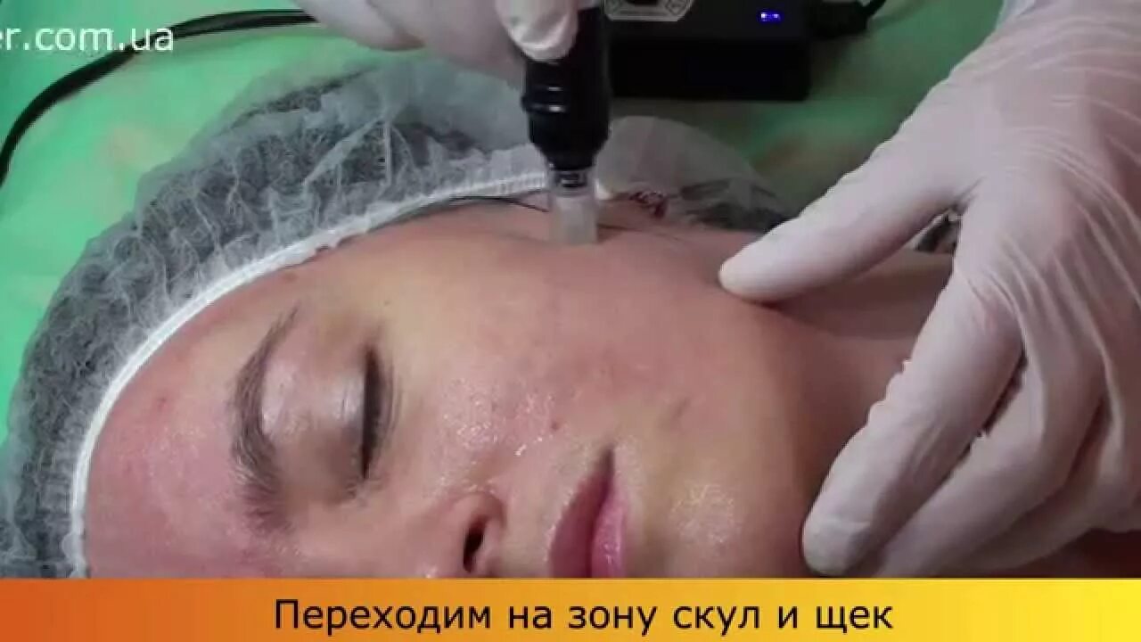 Дермапен что это за процедура. Мезотерапия безинъекционная дермапен. Дермапен что это за процедура. Мезотерапия акне дермапен. Дермапен что это за процедура.