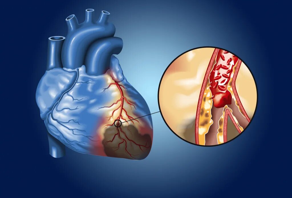 Ишемическая болезнь сердца. Ишемическая болезнь сердца. Coronary heart disease. Obesity and coronary artery disease. Сердце человека кардиология.