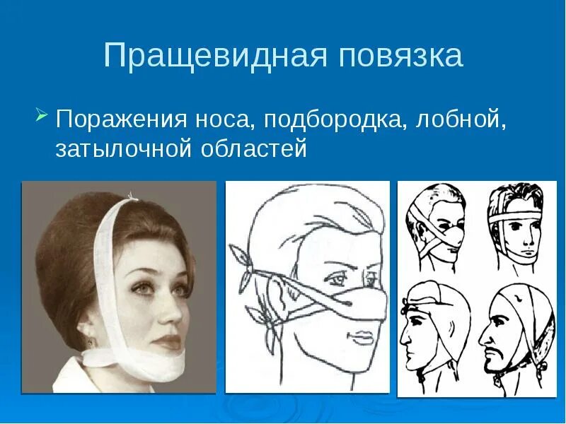 Техника наложения пращевидной повязки. Пращевидная повязка. Перевязка прощевидная. Пращевидная повязка на нос. Пращевидная повязка на нос алгоритм.