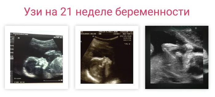 УЗИ 2 скрининг 20 недель. 21 Неделя беременности УЗИ скрининг. 21 weeks