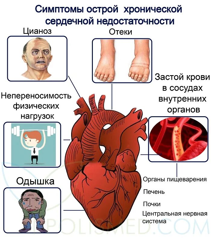 Признаки сердечной деятельности. Острое сердечное недостаточность симптомы. Острая хроническая недостаточность сердца. Симптомы острой сердечной недостаточности. Острая сердечная недостаточность симптомы.