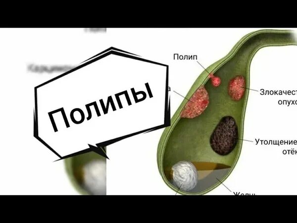 Народное лечение полипа в желчном пузыре. Полпа желчного пузыря?. Желчь полипы в желчном пузыре. Холестериновые полипы в желчном.