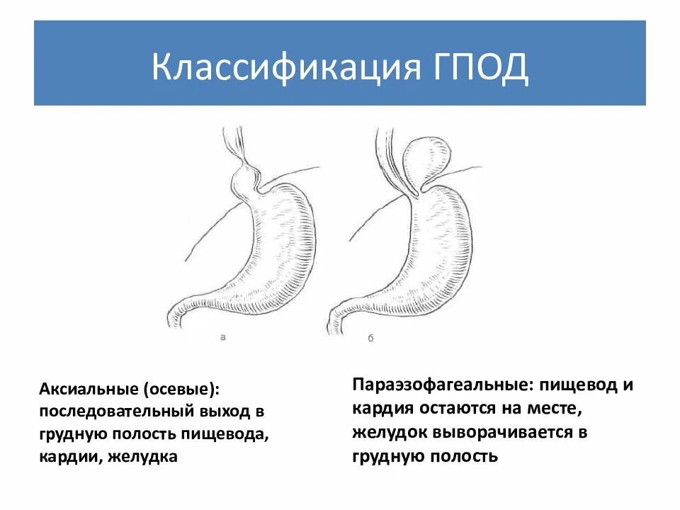 Скользящая грыжа под. Параэзофагеальная грыжа диафрагмы. Параэзофагеальная грыжа пищеводного отверстия. Скользящие и параэзофагеальные грыжи. Скользящая грыжа пищеводного отверстия диафрагмы классификация.