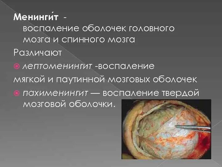 Воспаление оболочек головного и спинного мозга. Оболочка головного мозга менингит. воспаление мозговых оболочек. воспаление головного мозга.