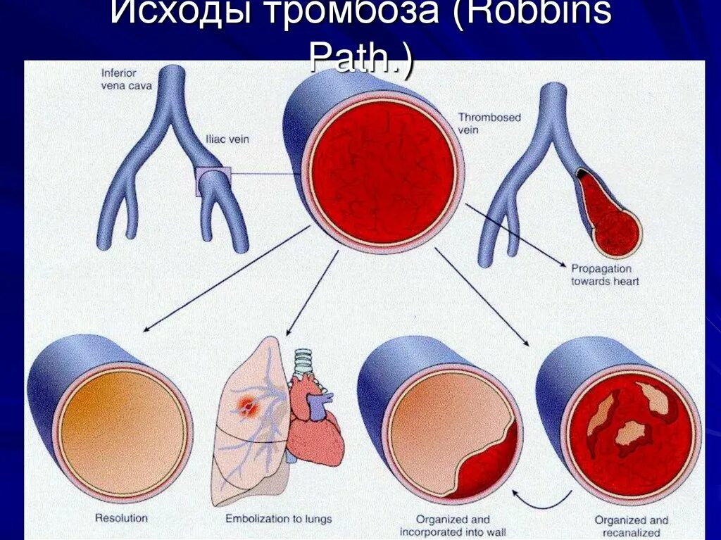 Исходы тромбоза. Исходы тромбообразования. Окклюзионный тромбоз