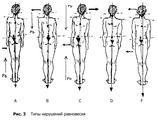 Дисбаланс как исправить. Типы нарушения постурального равновесия. постуральный мышечный дисбаланс это. постурология. постуральный дисбаланс мышц что это.