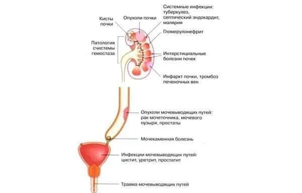 Почему писаешь кровью девушка. Кровь при мочеиспускании у мужчин. моча с кровью у мужчин причины.