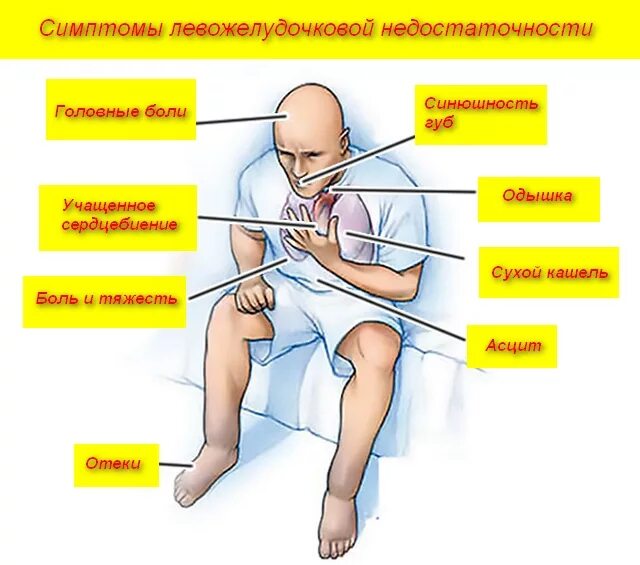 Оказание первой помощи при острой сердечной недостаточности. Острая сердечная недостаточность доврачебная помощь алгоритм. ПМП острой сердечной недостаточности. Сердечная недостаточность ПМП симптомы. Острая сосудистая недостаточность доврачебная помощь