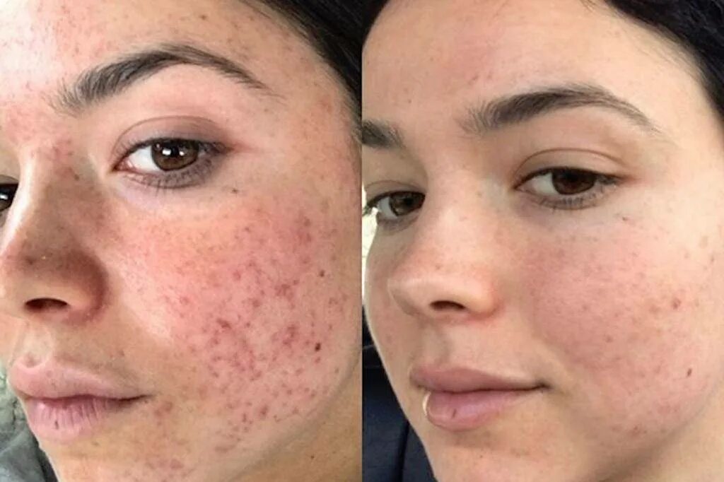 Как предотвратить акне. Как предотвратить акне. Как предотвратить акне. Акне и конглобатные угри. Как предотвратить акне.