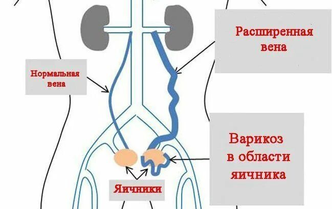 Варикоз малого таза симптомы лечение. Расширение малого таза вена. варикозное расширение вен малого таза. варикозно расширенные вены малого таза. варикозное расширение вен тазового дна.