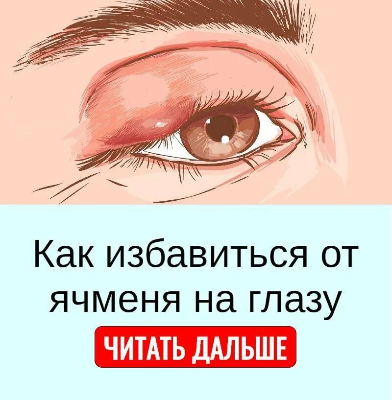 Я чмень на глощу. Ячмень на глазу первый день. Ячмень начинает