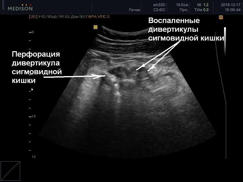 Дивертикулез толстой кишки на УЗИ. Дивертикулез кишечника на УЗИ. Дивертикулит сигмовидной кишки на УЗИ. Дивертикул кишечника на УЗИ. На узи видно воспаление