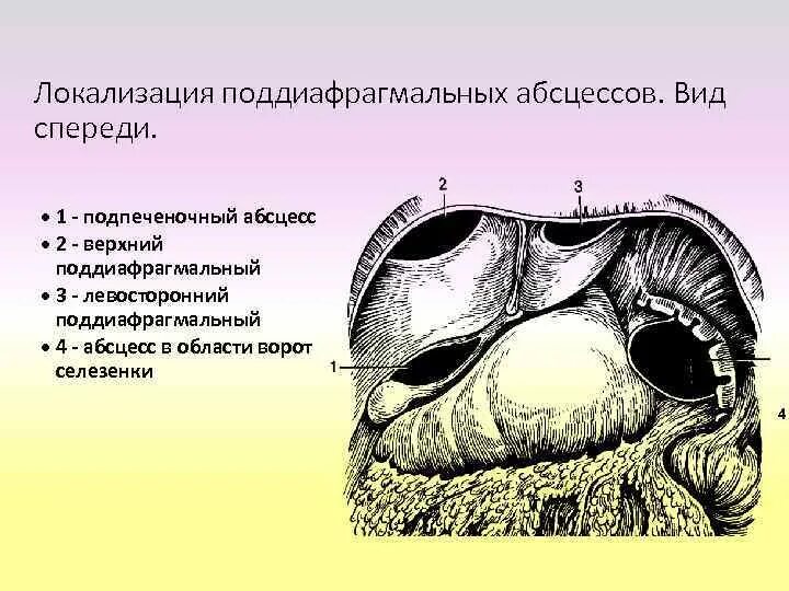 Подпеченочный абсцесс. Локализация поддиафрагмального абсцесса. Поддиафрагмальное пространство. Правое и левое поддиафрагмальное пространство. Поддиафрагмальное пространство топографическая анатомия.