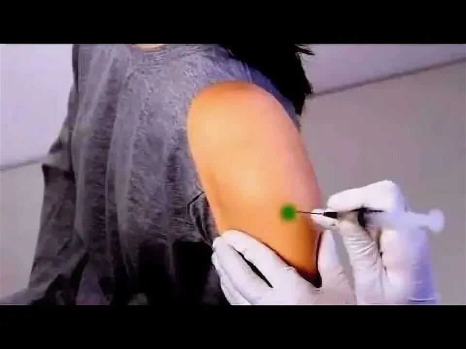 Внутримышечная инъекция в дельтовидную мышцу. Угол введения иглы при внутримышечной инъекции в плечо. Подкожное введение лекарственных средств места. Место укола в плечо. Новокаиновая блокада плечевого сустава методика.