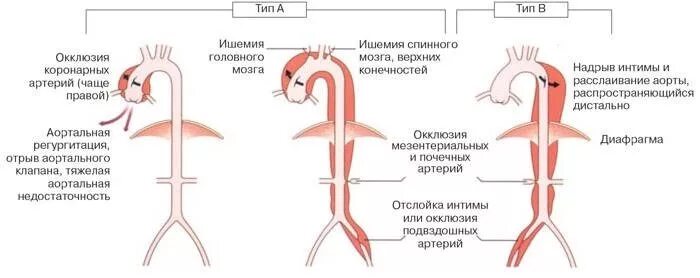 Аневризма аорты мкб 10. Классификация аневризм восходящего отдела аорты. расслаивающаяся аневризма аорты патогенез. расслоение дуги аорты на кт. классификация аневризм грудного отдела аорты.
