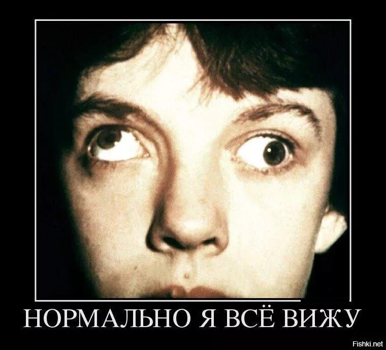 Эзотропия сходящееся косоглазие. Межъядерная офтальмоплегия симптомы. Глаза в разные стороны болезнь. Гипертропия косоглазие. Монолатеральное косоглазие.