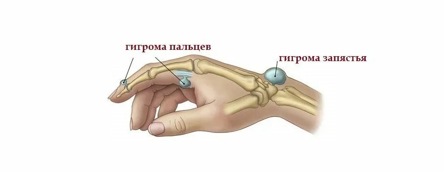 Заговор от гигромы