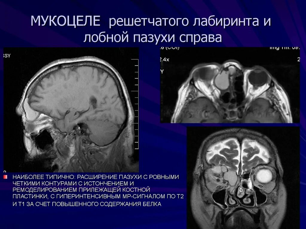 Мукоцеле синуса. Мукоцеле верхнечелюстной пазухи кт. Мукоцеле решетчатого лабиринта кт. Мукоцеле носового синуса кт. Мукоцеле лобной пазухи на кт.